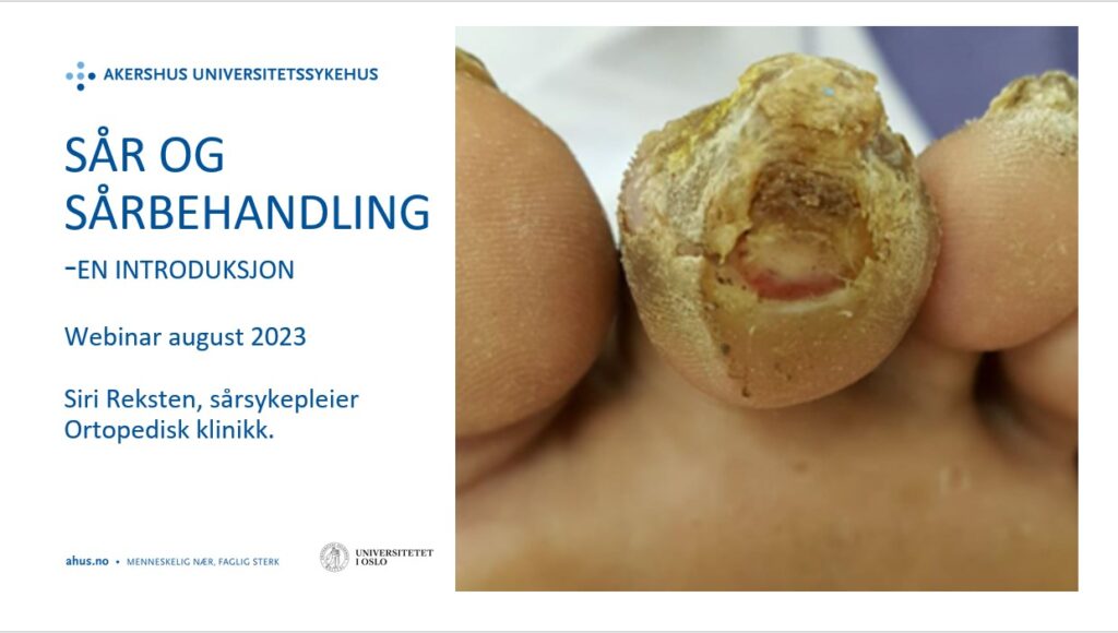 Sår og sårbehandling- en introduksjon. Webinar august 2023. Siri Reksten, sårsykepleier, Ortopedisk klinikk. Tå med et åpent sår.