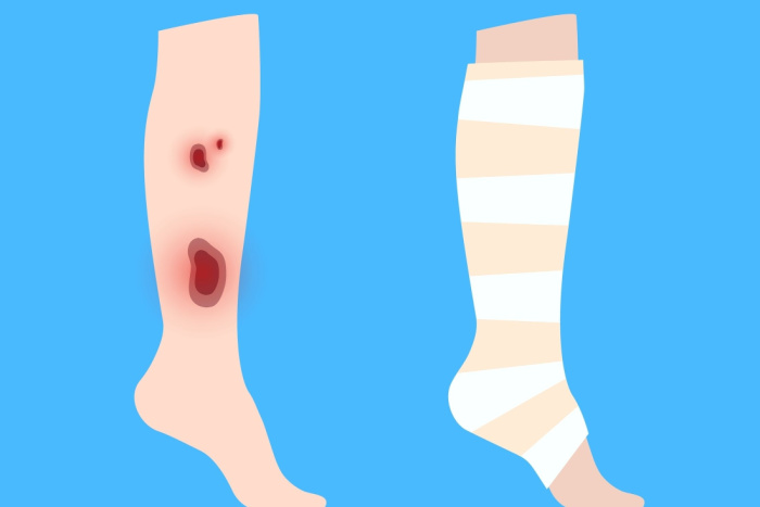 Tegning på blå bakgrunn som viser en legg med sår og en legg med bandasje