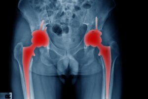Røntgen bilde av to hofter der begge sider er markert med rødt