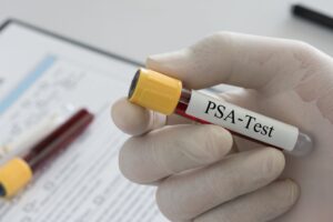 Lege med handsker som holder et prøveglass merket PSA test