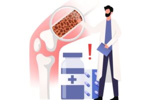 Illustrasjonsbilde av lege som står forran et ben med forstørrelsesglass mot knebein preget av osteoperose. I bildet er det også bilde av et medisinglass og et utropstegn, ment å illustrere behandling av osteoperose.