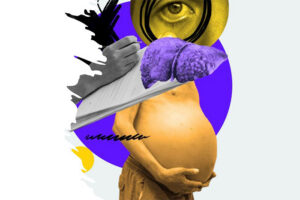 Bilde av leverpasient med stor mage