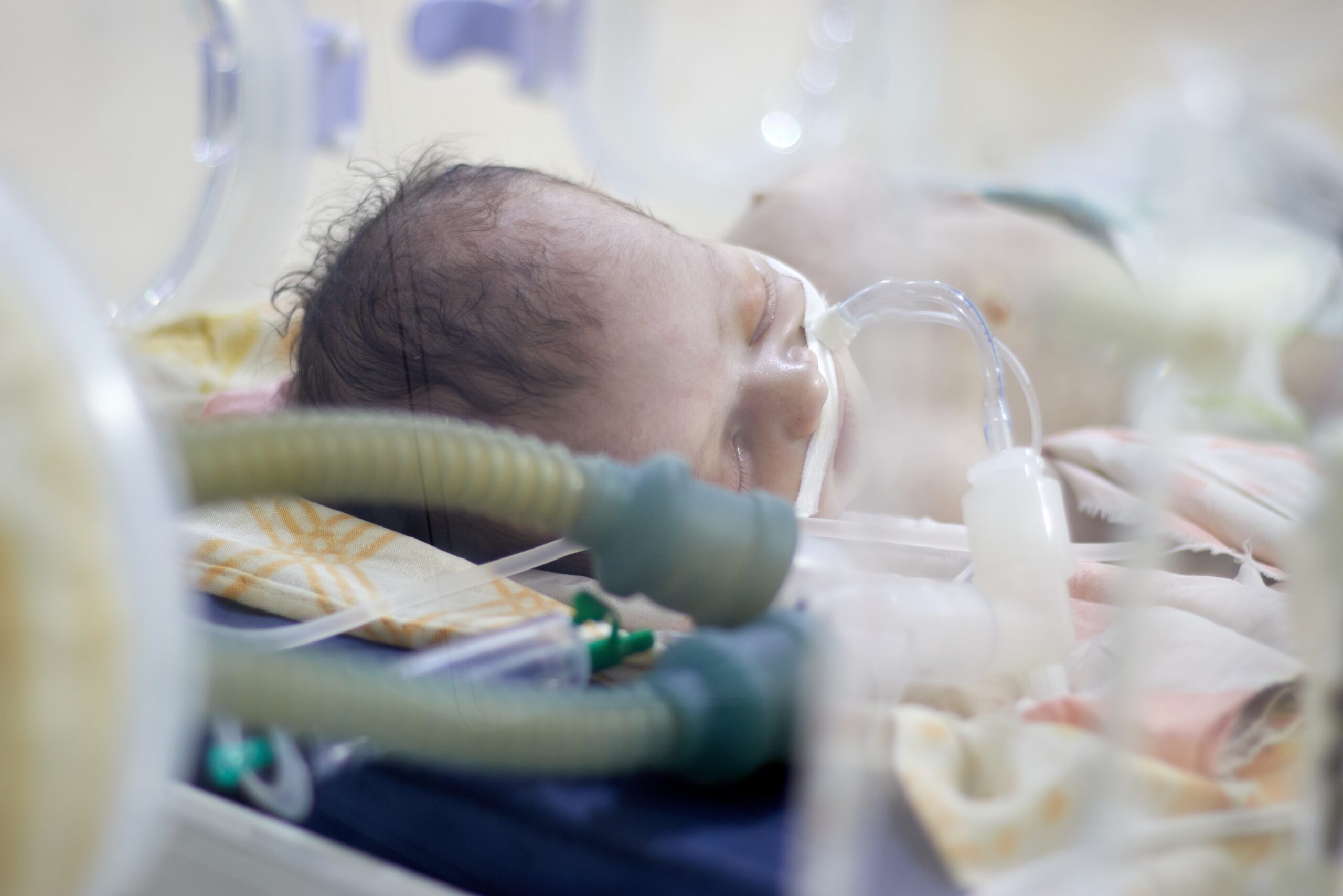 Bilde av baby i respirator, slanger liggende rundt hodet. Foto.