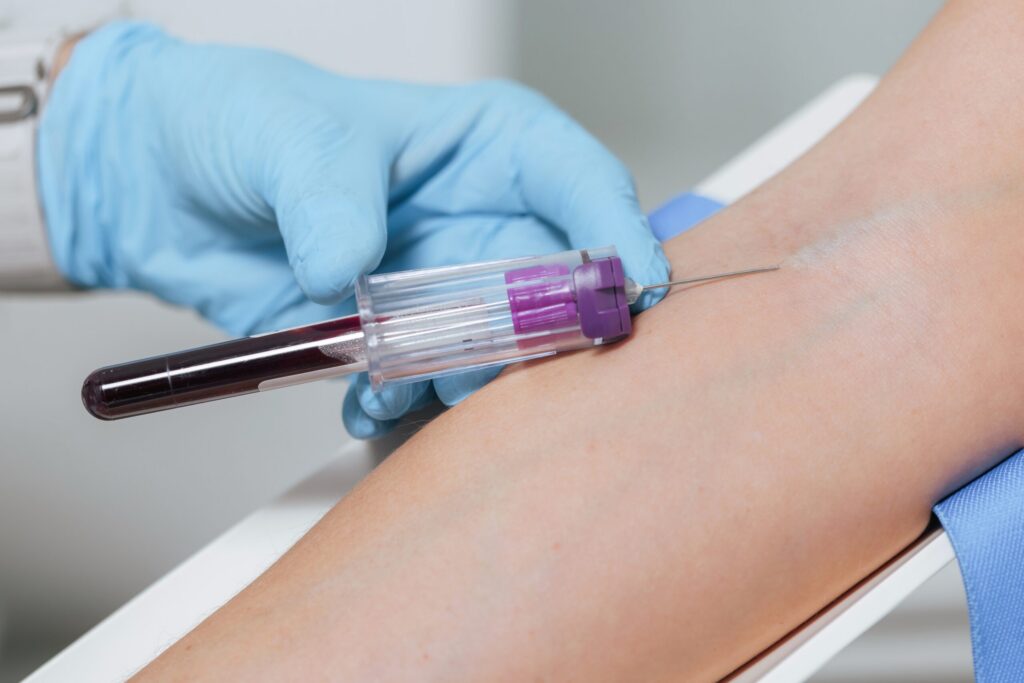 Blodprøvetaking. Hanskekledd hånd som samler blod fra pasientens arm.