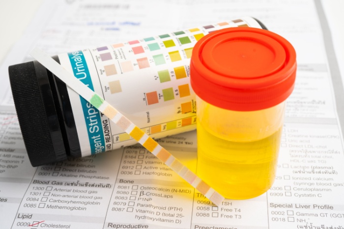 Bilde av en urinstrimmeltest og et urinprøveglass med urin.