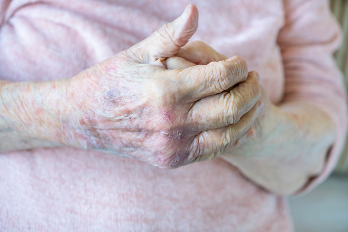 Gammel dame folder hendene sine. Har rosa genser og sår på hendene. Foto